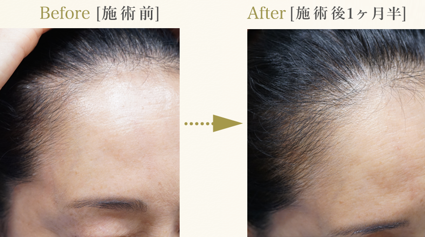 症例：ダブル(D)58歳女性「生え際部位脱毛改善」