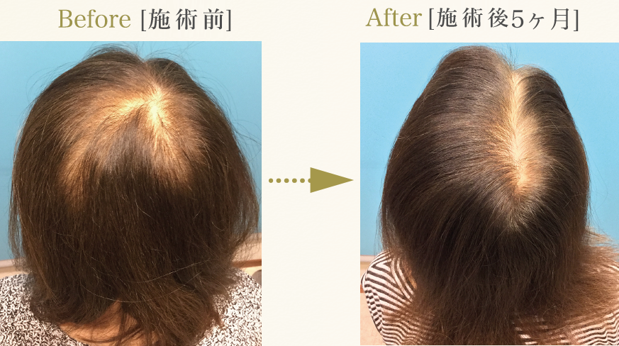 症例：ダブル(D)65歳女性「頭頂部脱毛改善」