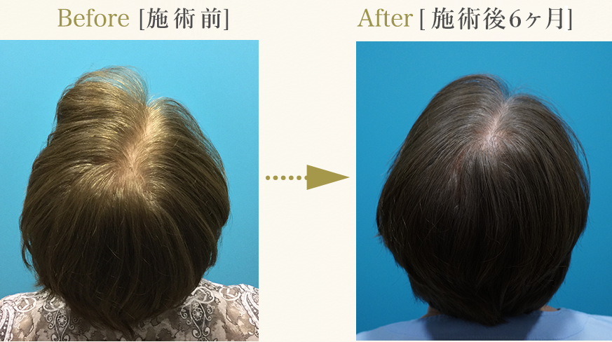 症例：トリプル(T)72歳女性「頭頂部脱毛改善」